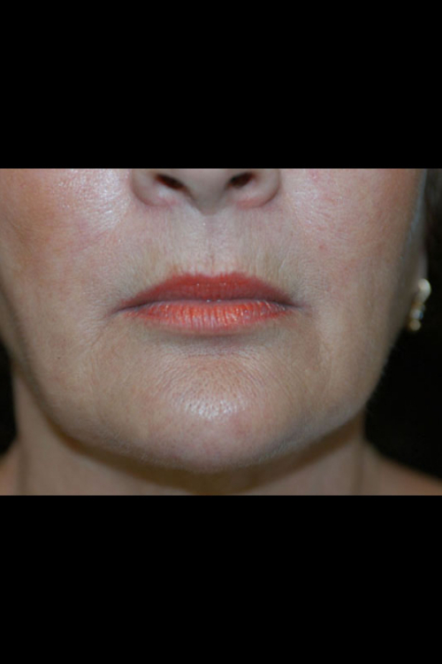 Lip Augmentation