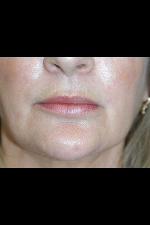 Lip Augmentation