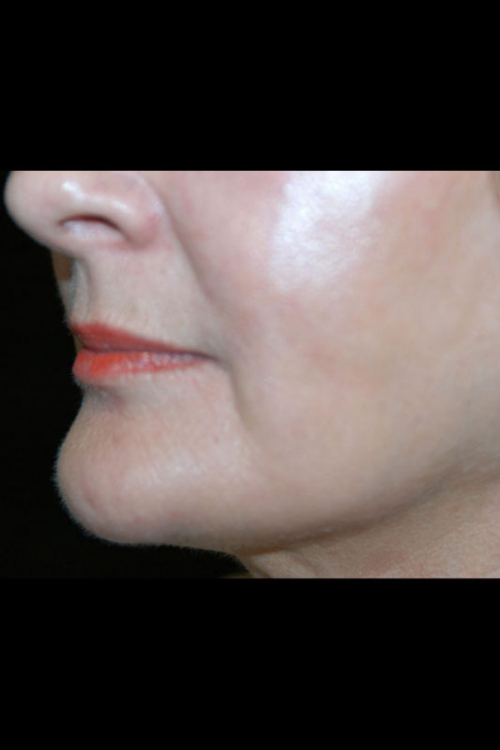 Lip Augmentation