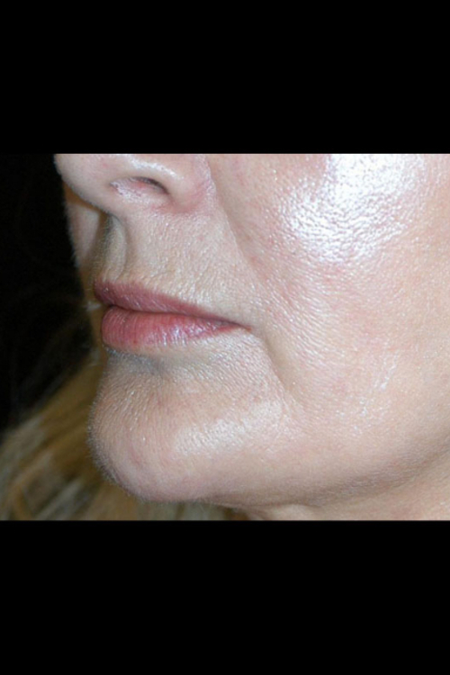 Lip Augmentation