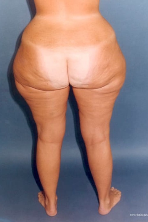 Liposuction - Body