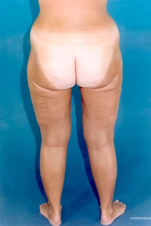 Liposuction - Body