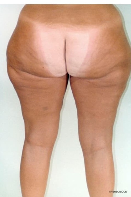 Liposuction - Body