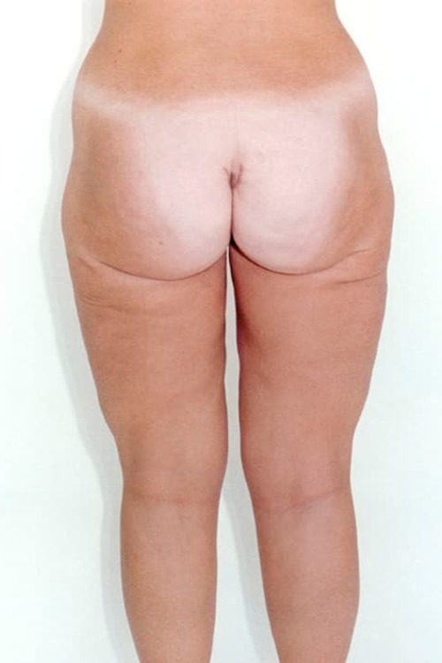 Liposuction - Body