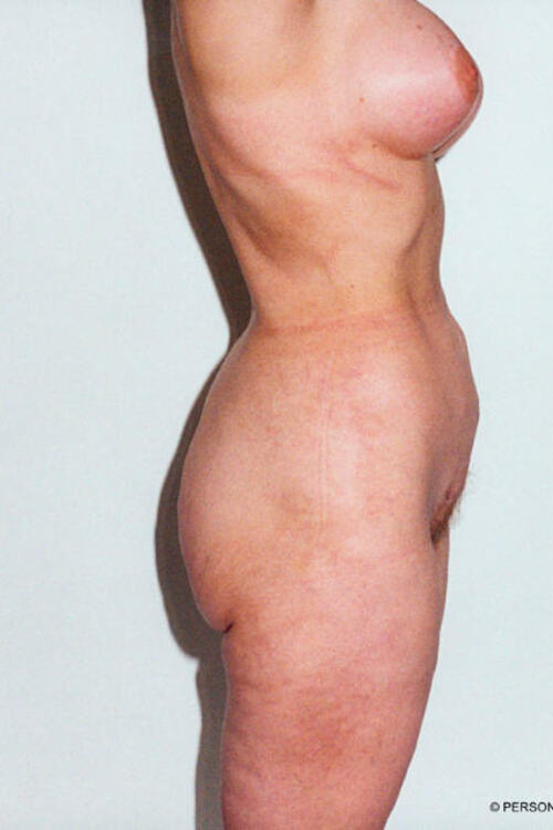 Liposuction - Body