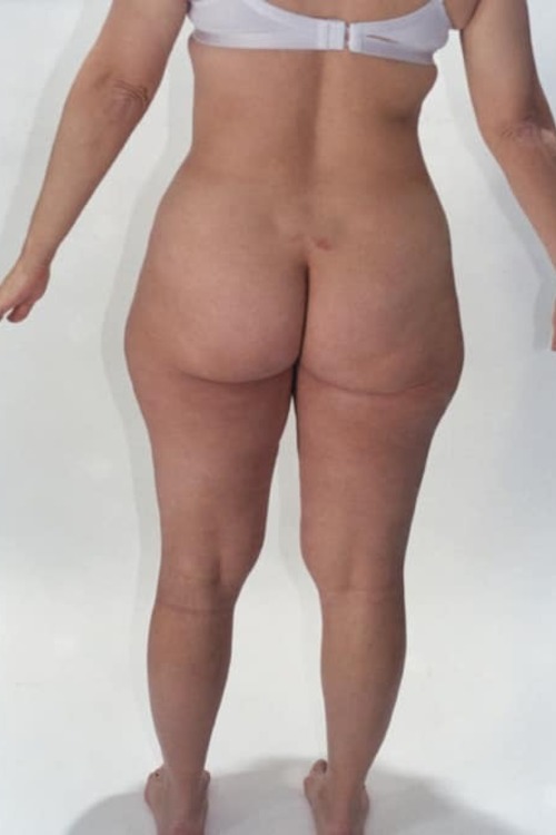 Liposuction - Body