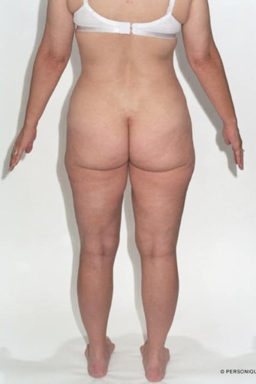 Liposuction - Body