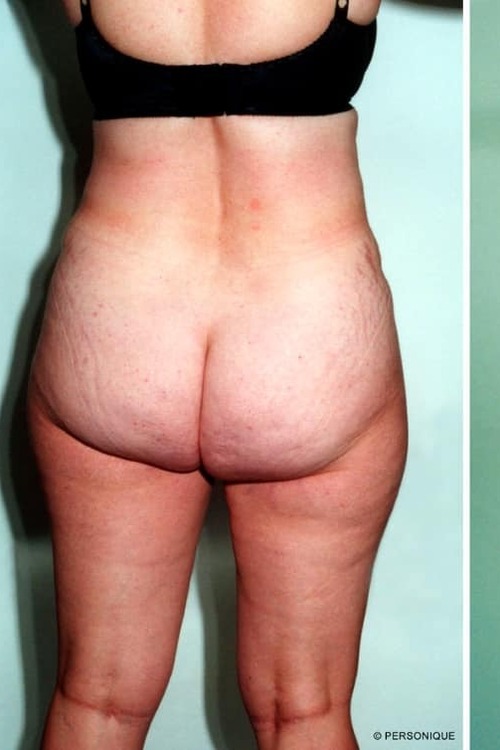 Liposuction - Body