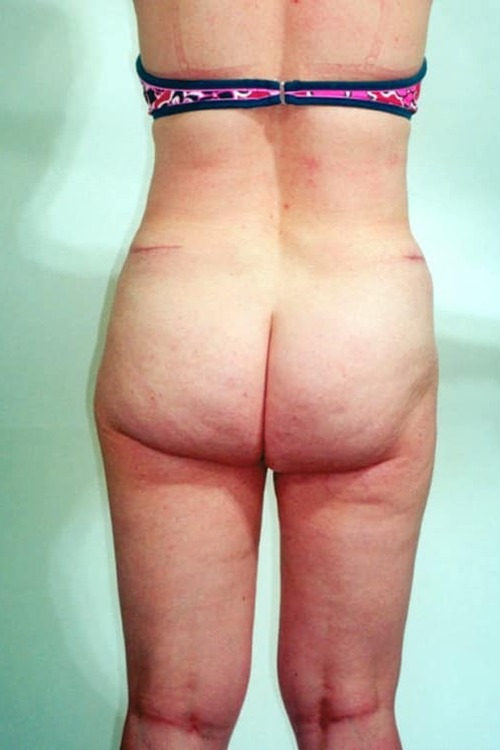 Liposuction - Body