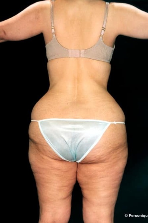 Liposuction - Body