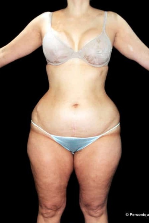 Liposuction - Body