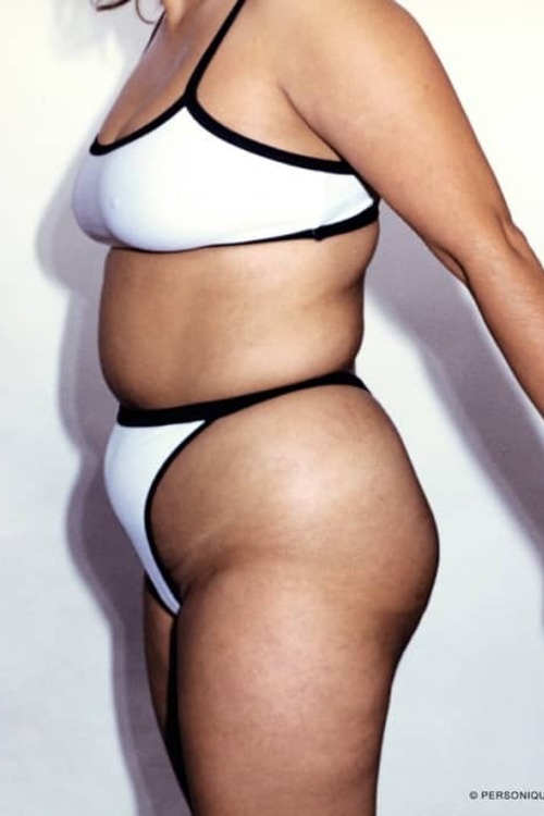 Liposuction - Body