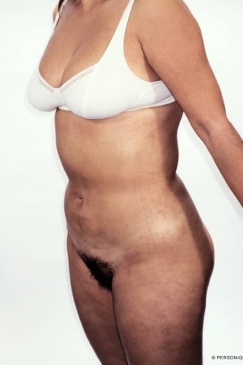 Liposuction - Body