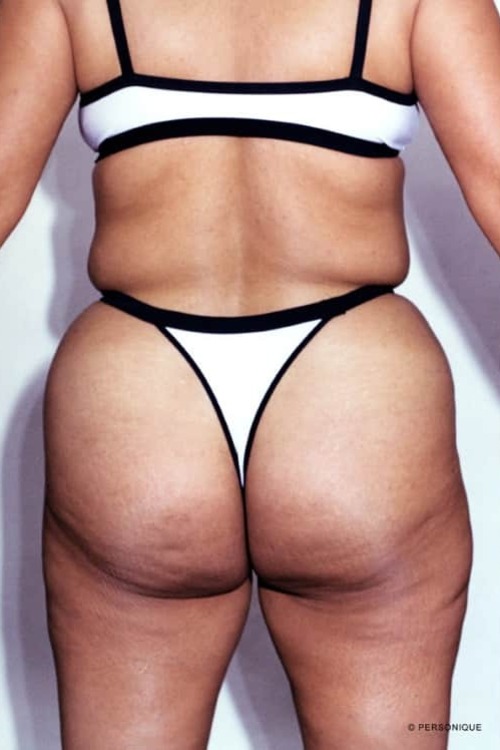 Liposuction - Body