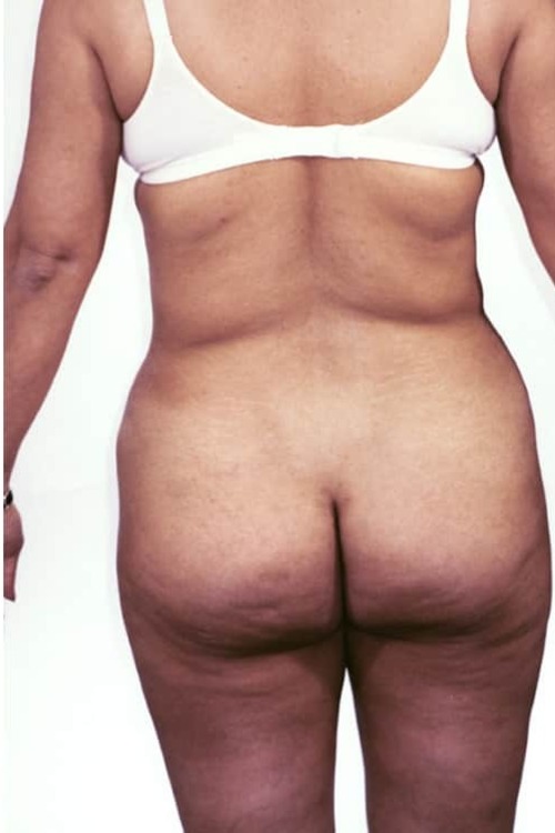 Liposuction - Body