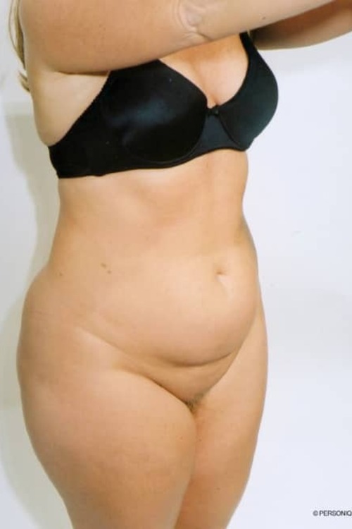 Liposuction - Body