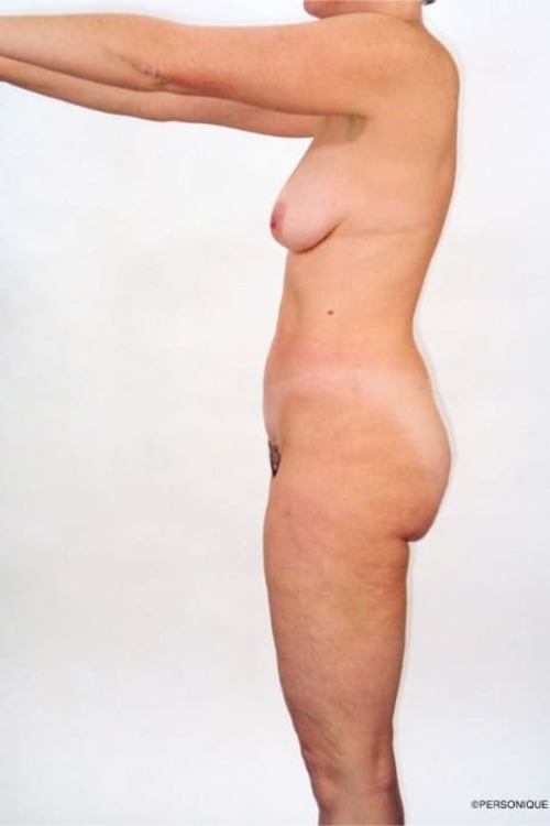 Liposuction - Body