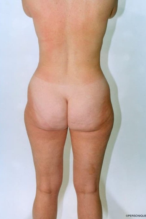 Liposuction - Body