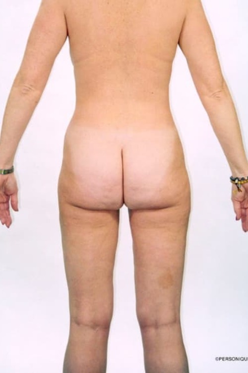 Liposuction - Body