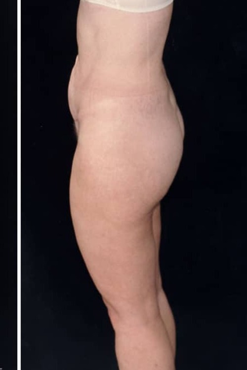 Liposuction - Body