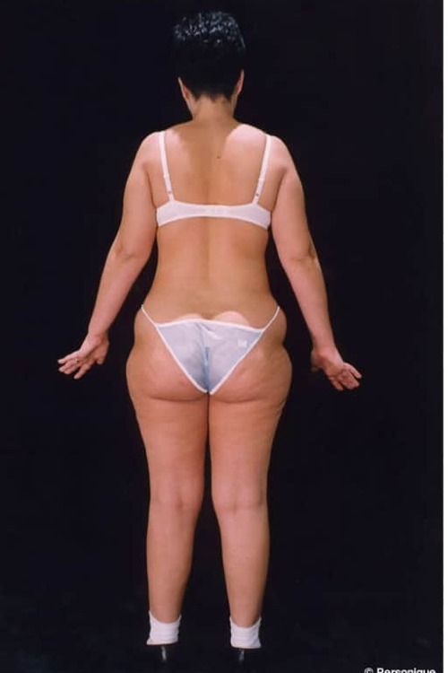 Liposuction - Body