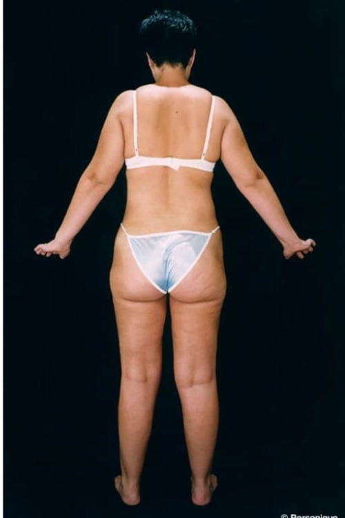 Liposuction - Body