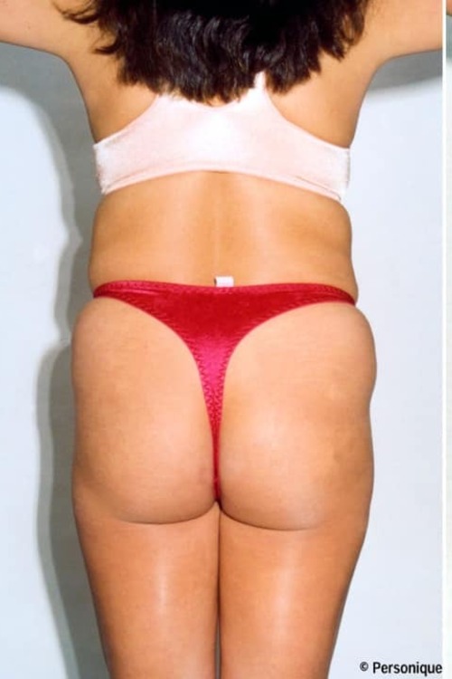 Liposuction - Body