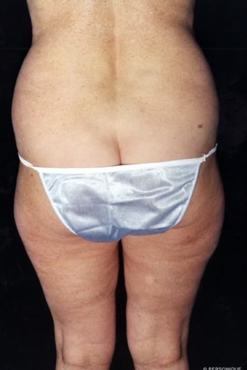 Liposuction - Body