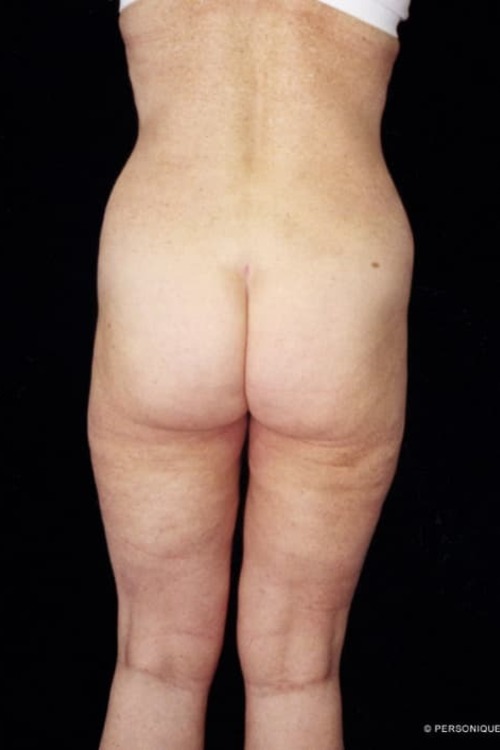 Liposuction - Body