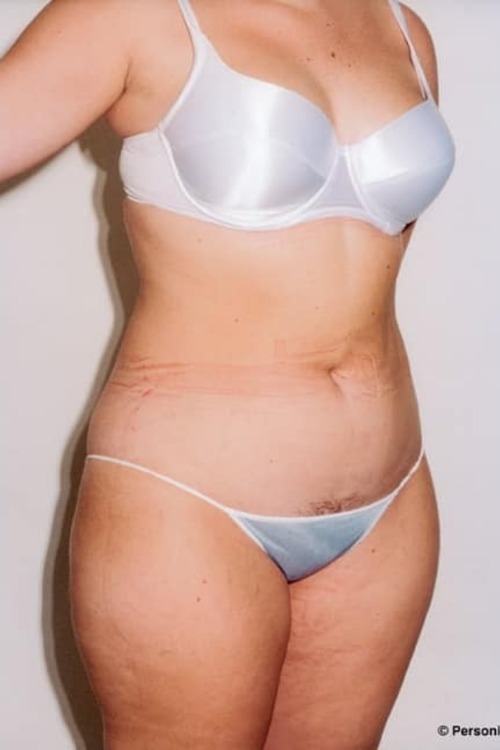 Liposuction - Body