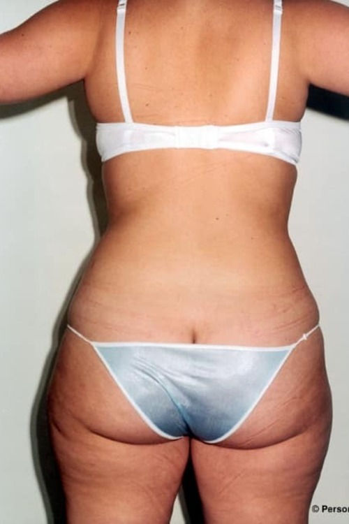 Liposuction - Body