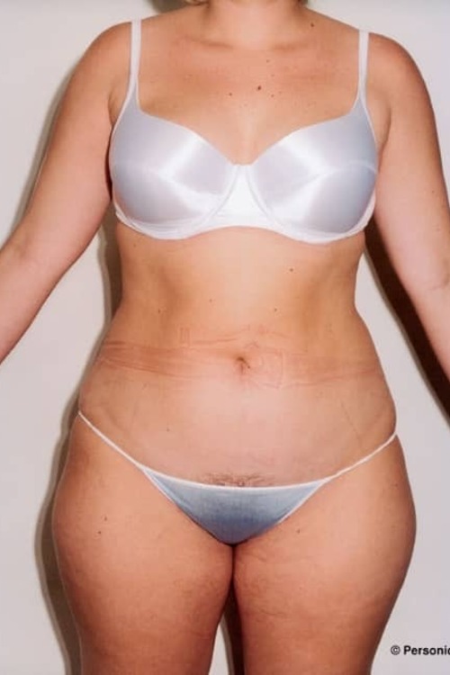 Liposuction - Body