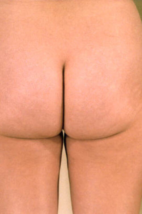 Liposuction - Body