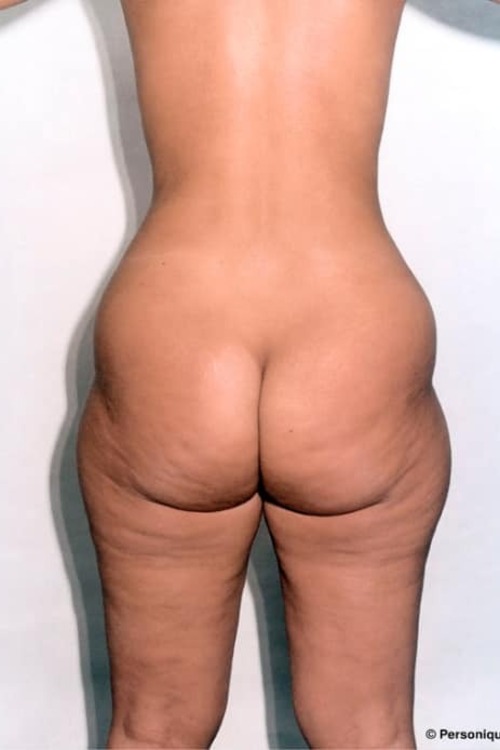 Liposuction - Body