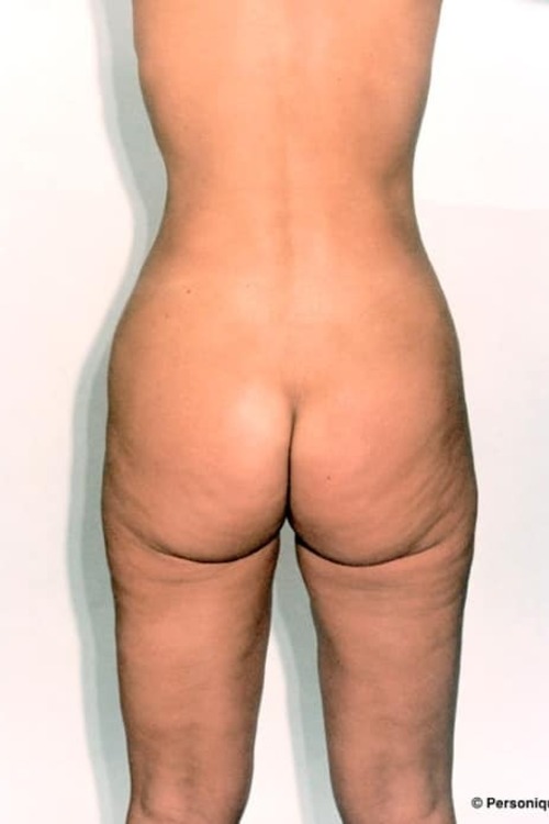 Liposuction - Body