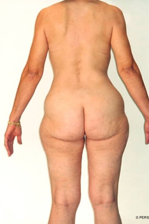 Liposuction - Body