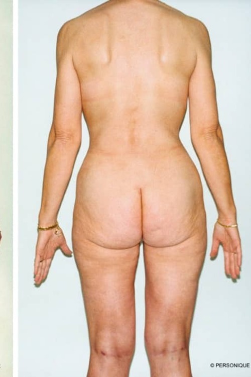 Liposuction - Body