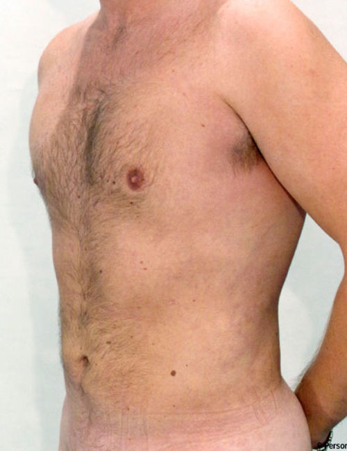 Liposuction - Body