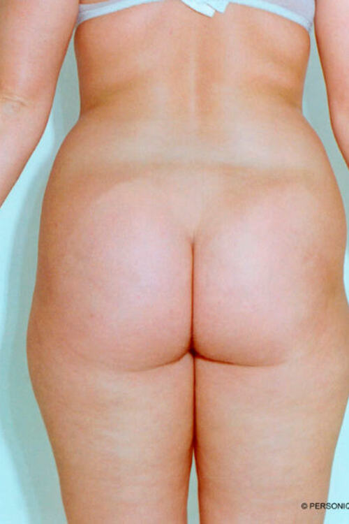 Liposuction - Body