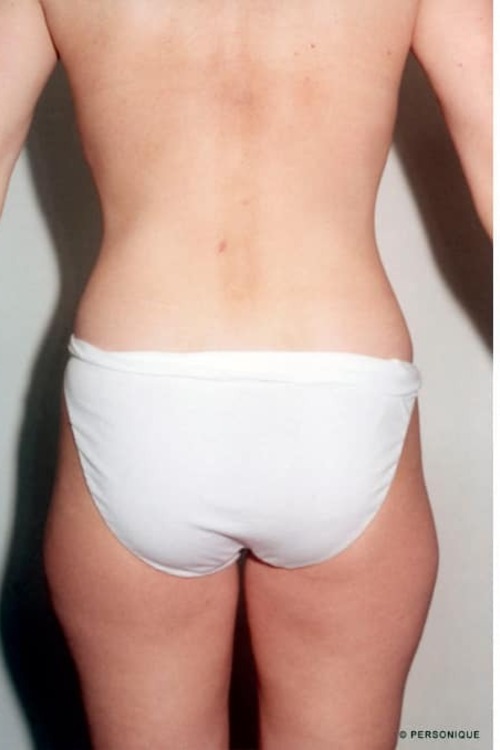 Liposuction - Body