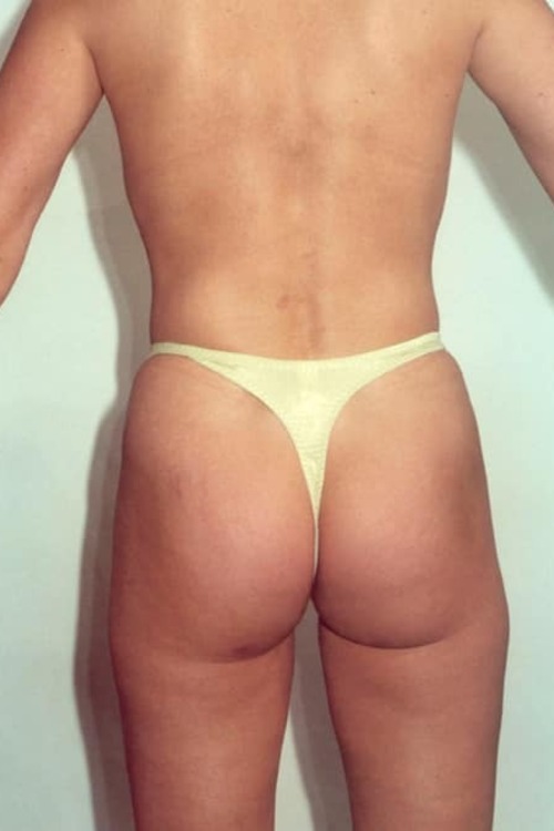 Liposuction - Body