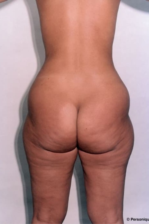 Liposuction - Body