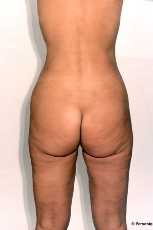 Liposuction - Body