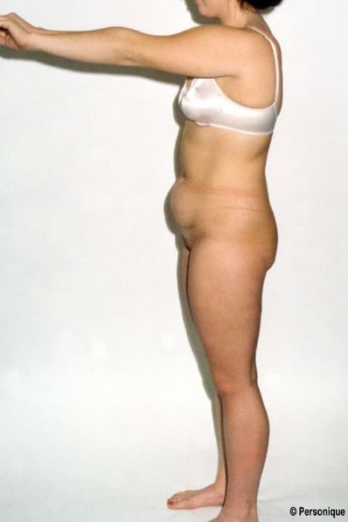 Liposuction - Body