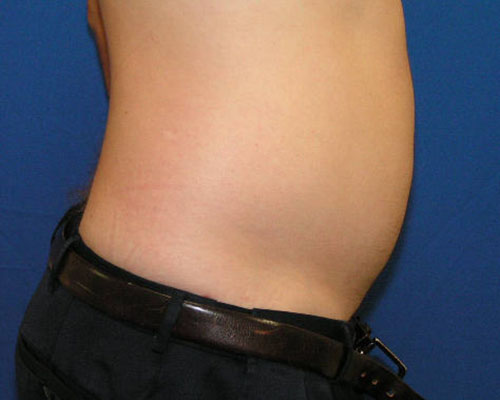 Male Liposuction