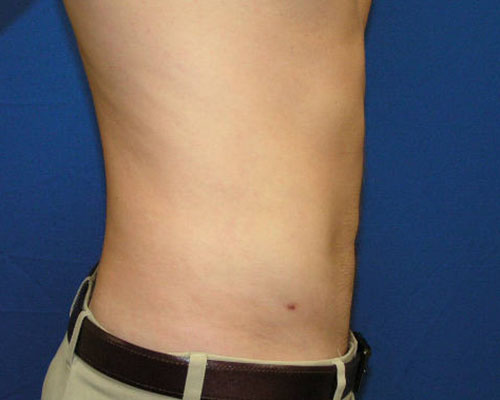 Male Liposuction