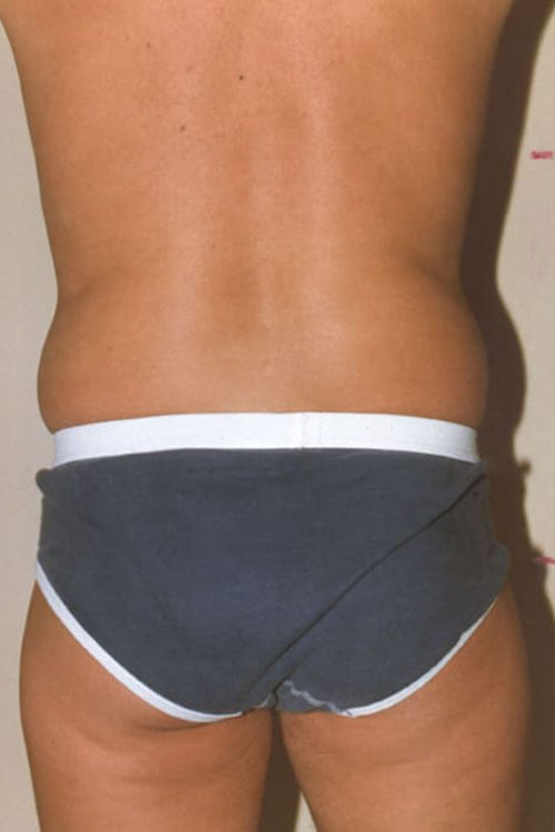 Liposuction - Body