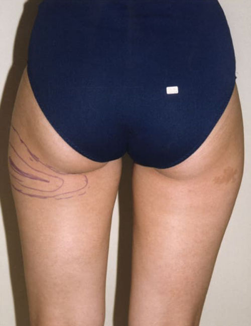 Liposuction - Body