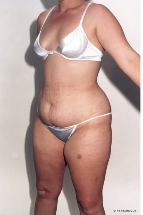 Liposuction - Body