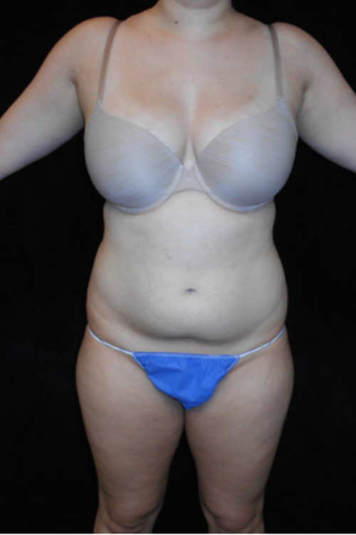 Liposuction - Body